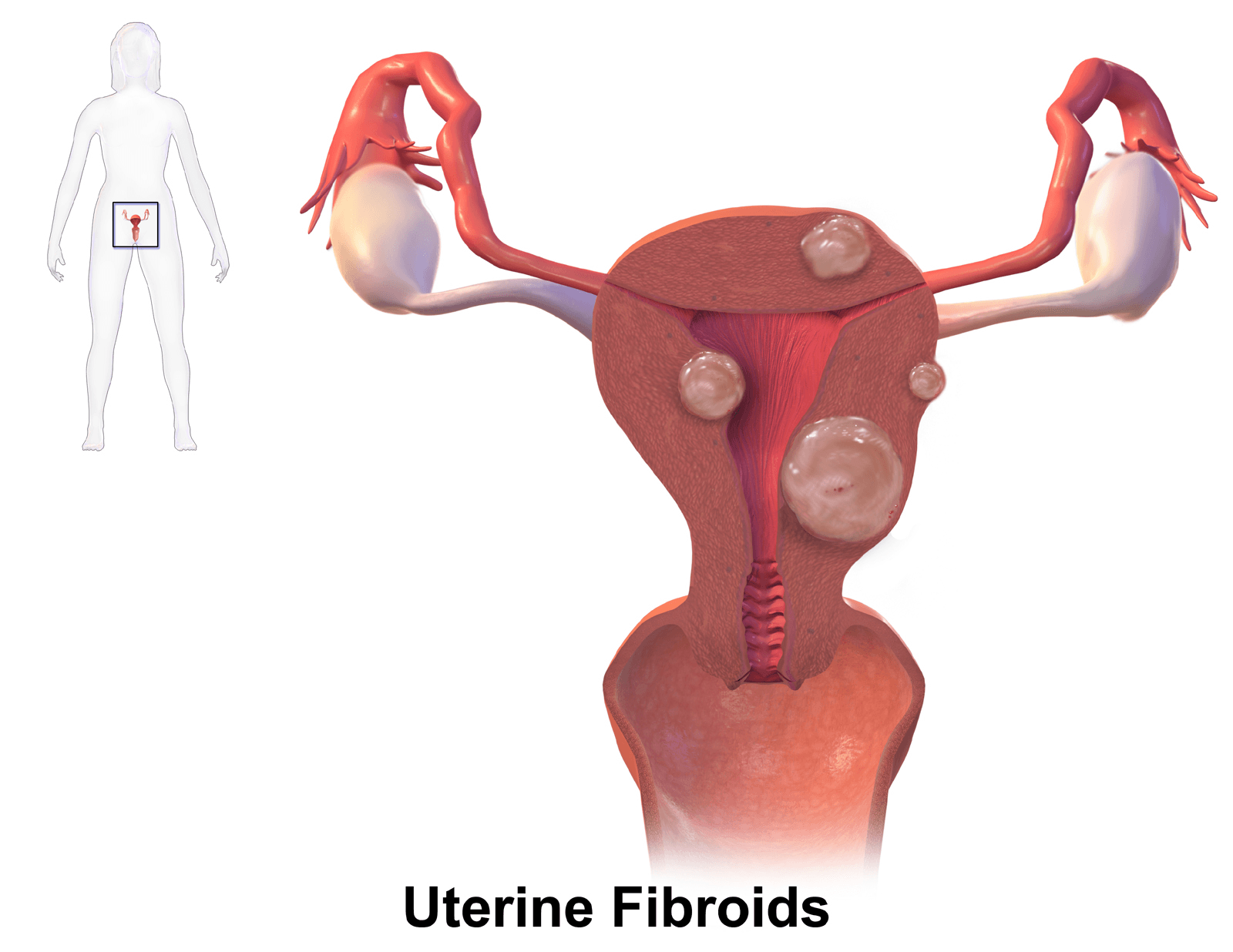 Uterine Fibroids: FIGO Classification Chart